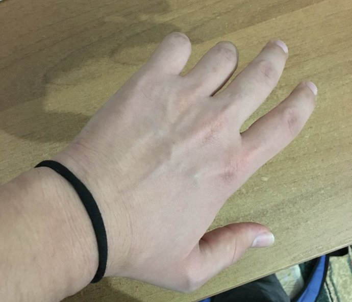 Bir kızın bileğinde toka neden olur? - Kapak Görseli